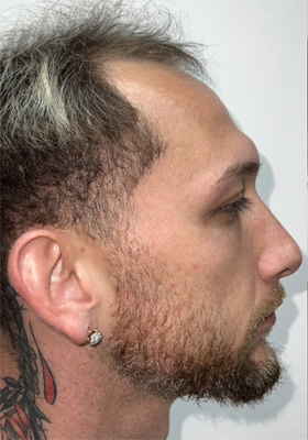 hair transplant photos