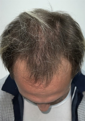 hair transplant photos