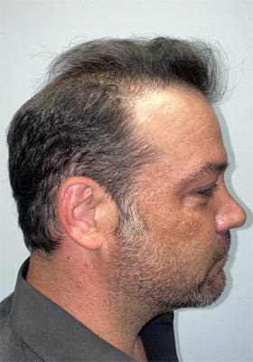hair transplant before after Photos