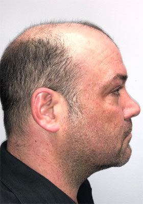 hair transplant before after Photos