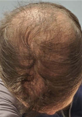 hair transplant photos