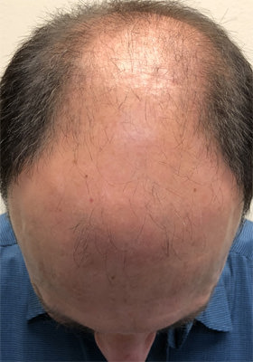 hair transplant photos