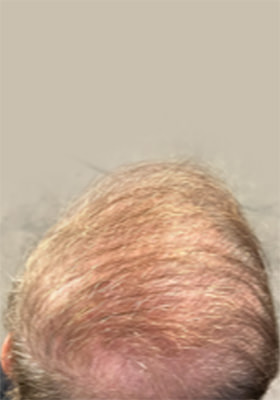 hair transplant photos