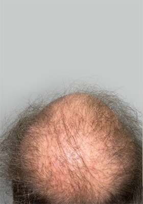 hair transplant photos