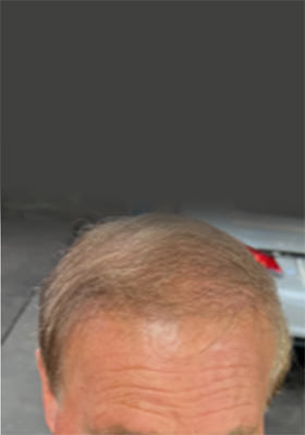 hair transplant before after Photos