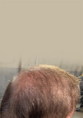 hair transplant before after Photos