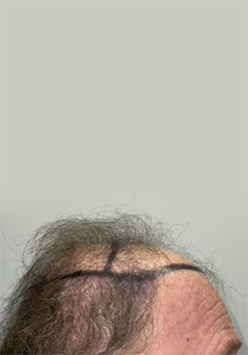 hair transplant photos