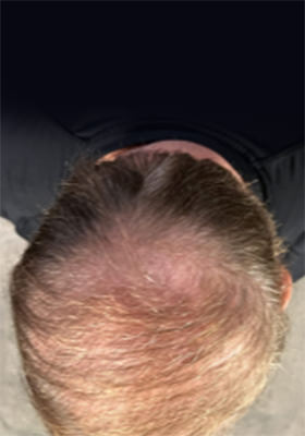 hair transplant before after Photos