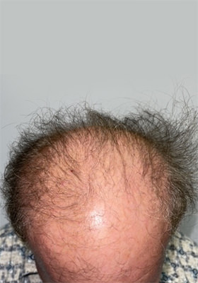 hair transplant photos