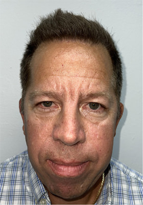 hair transplant photos