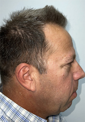 hair transplant before after Photos