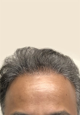 hair transplant before after Photos