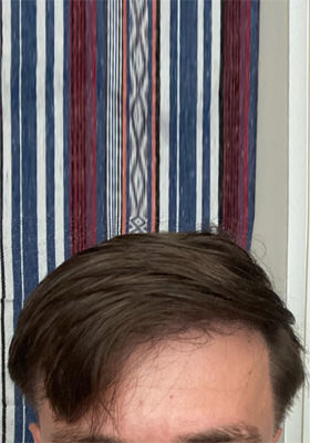 hair transplant photos