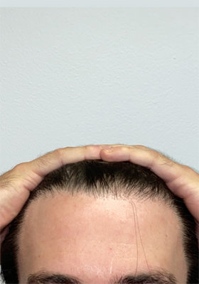 hair transplant photos