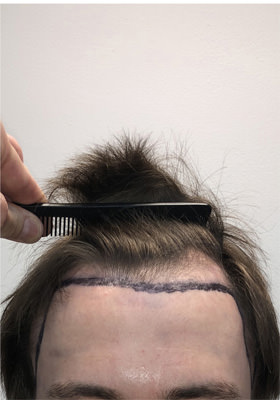 hair transplant photos