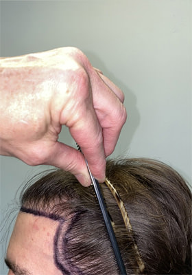 hair transplant photos