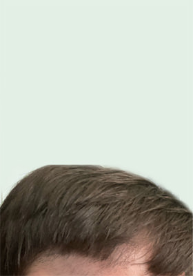 hair transplant photos