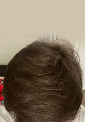 hair transplant photos