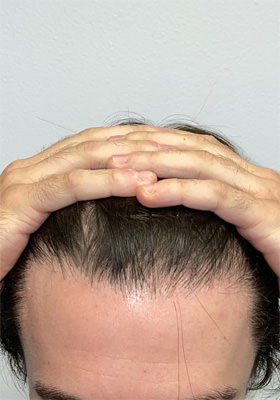 hair transplant photos