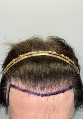 hair transplant photos