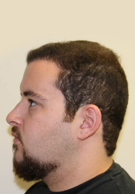 hair transplant photos