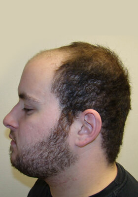 hair transplant before after Photos