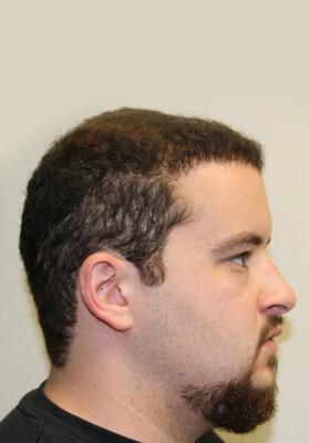 hair transplant photos