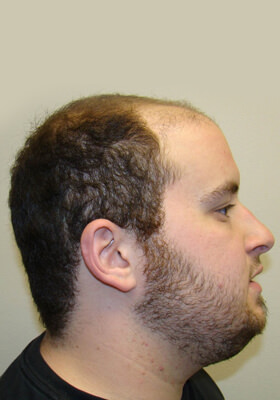 hair transplant before after Photos