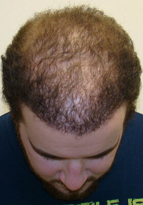 hair transplant photos