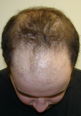 hair transplant photos