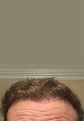 hair transplant photos