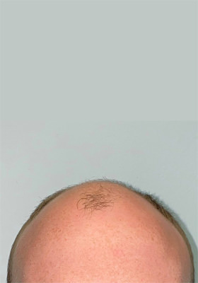 hair transplant before after Photos