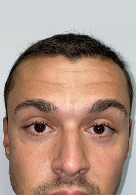 hair transplant before after Photos