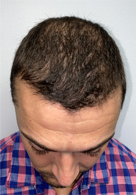 hair transplant before after Photos