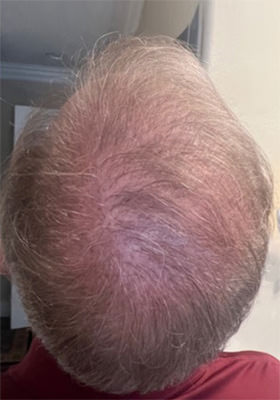 hair transplant photos