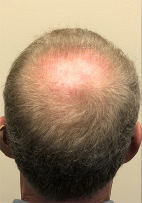 hair transplant photos