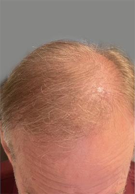 hair transplant before after Photos