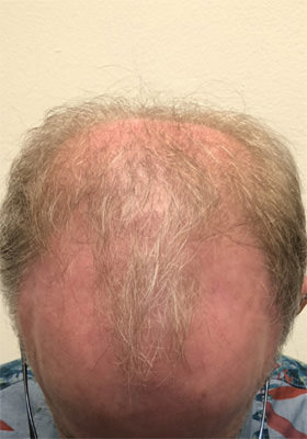 hair transplant photos