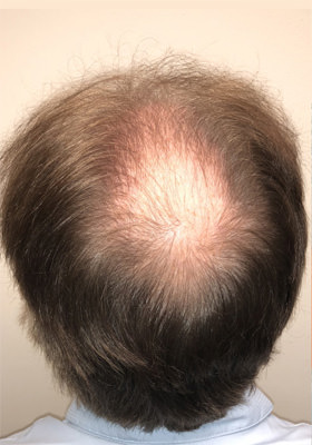 hair transplant photos