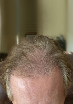 hair transplant before after Photos