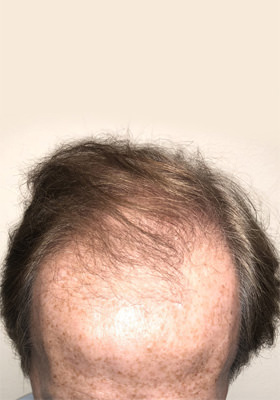 hair transplant before after Photos