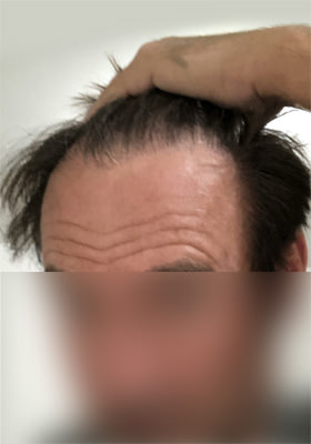 hair transplant photos