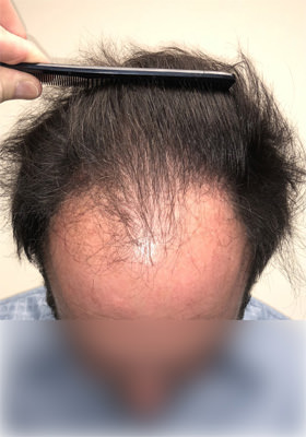 hair transplant before after Photos