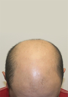 hair transplant before after Photos