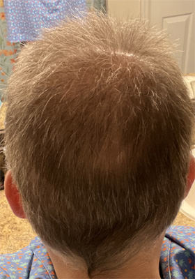 hair transplant photos