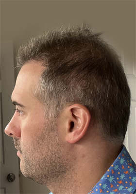 hair transplant photos