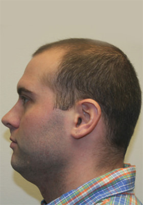 hair transplant photos