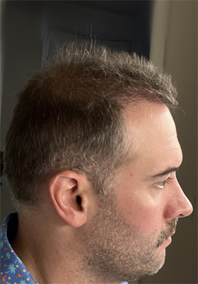 hair transplant photos