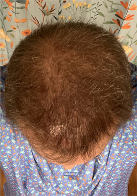 hair transplant photos