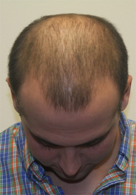 hair transplant before after Photos